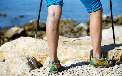 Varicose Veins – How do they develop and how can they be managed?